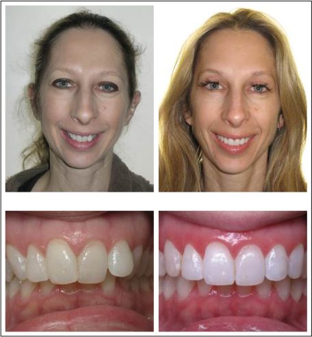 Invisalign Case Study