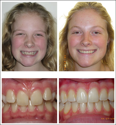 Orthodontic treatment for children