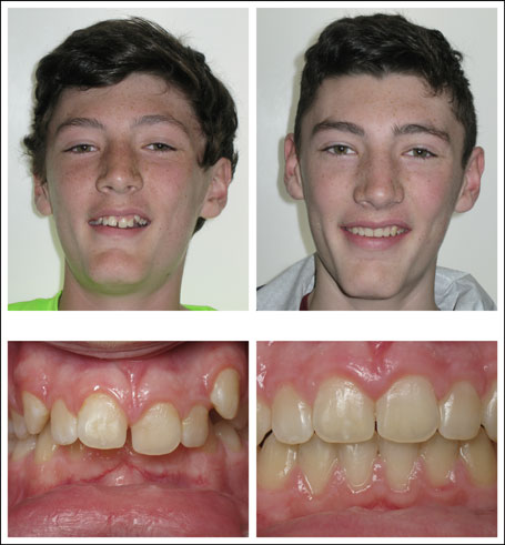 Orthodontic treatment for children