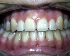 Orthodontic Treatment Case Study