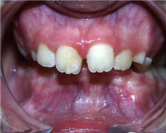 Orthodontic Treatment Case Study