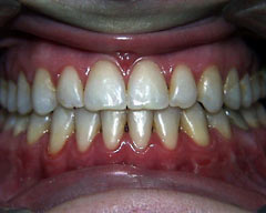 Orthodontic Treatment Case Study