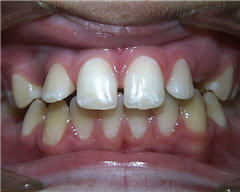 Orthodontic Treatment Case Study