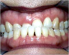 Orthodontic Treatment Case Study