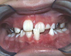 Orthodontic Treatment Case Study