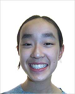 Orthodontic Treatment Case Study