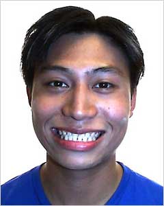 Orthodontic Treatment Case Study